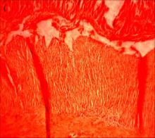 Деструктивні зміни м'язової оболонки клубової кишки. Забарвлення гематоксиліном та еозином. Мікропрепарат. Об. 10, ок. 10.