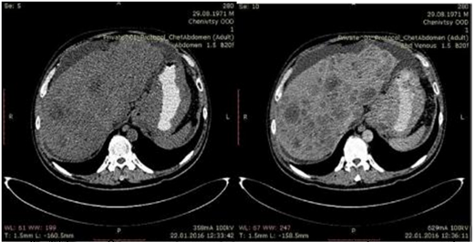 КТ хворого О. на рак кардіального відділу шлунка з метастазами у печінку та заочеревинні лімфовузли.